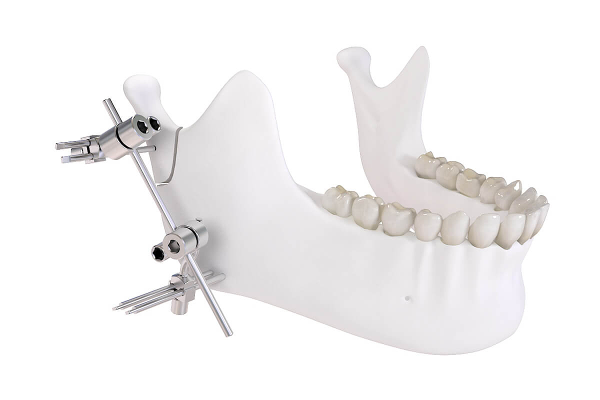 C.E.F. Fijador externo para fractures condilares